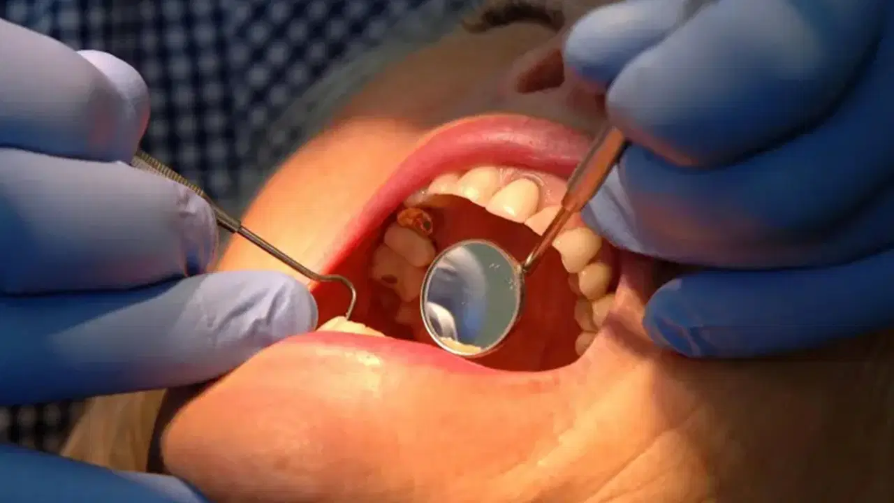 dis minesini onaran yeni jel curuklerin sonu mu geliyor ml73BjQc.jpg